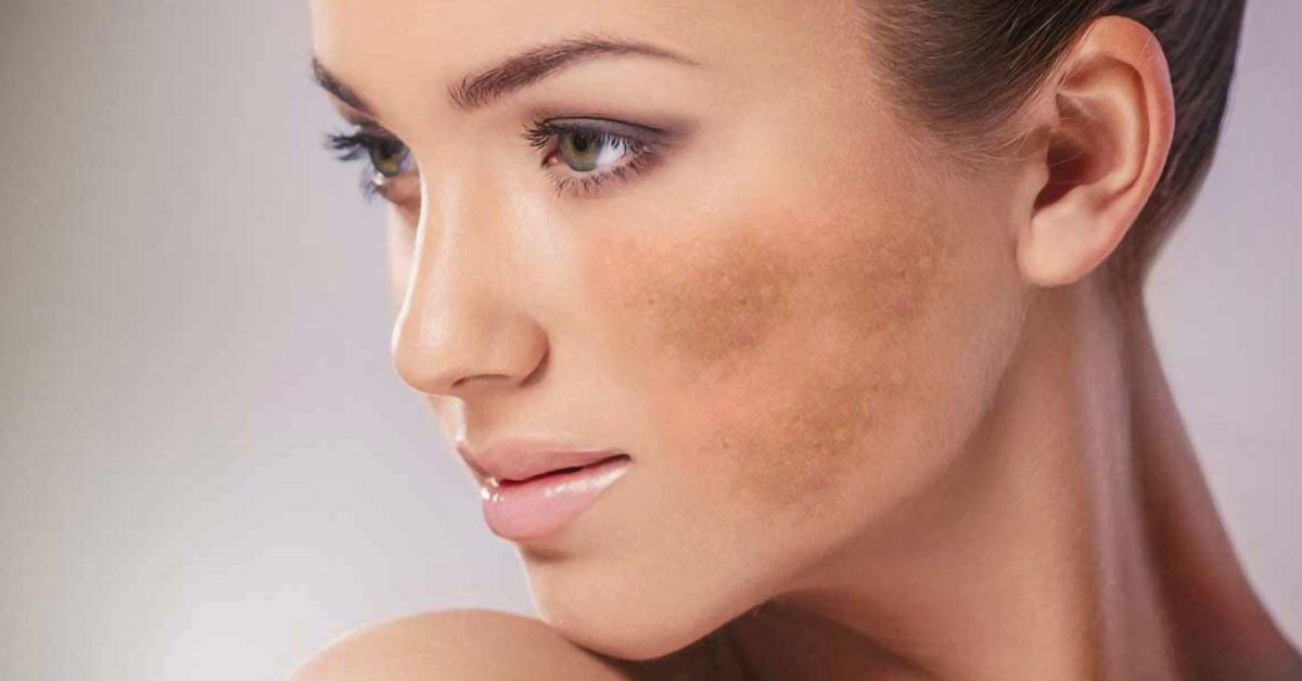 Sua jornada para tratar o melasma começa aqui