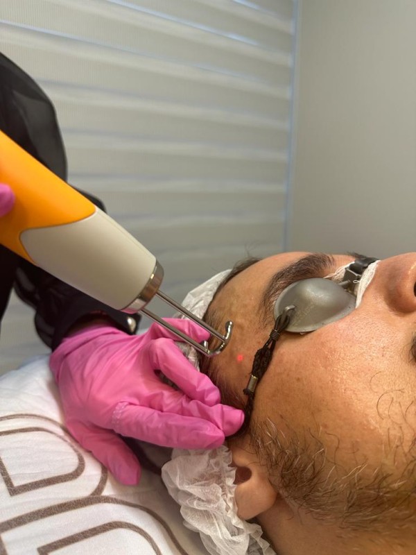 Imagem de Peeling com Tecnologias